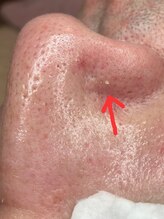 KMB 中崎町店/毛穴エクストラクションモンロー