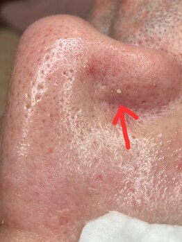 KMB 中崎町店/毛穴エクストラクションモンロー