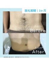 メンズクリア 広島店/【メンズクリア】お客様の施術例