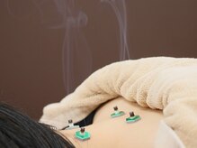 ほねつぎ 高津はりきゅう接骨院/お灸で冷え解消★