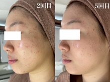 ホワイトアクア 梅田本店(WHITE AQUA)/ハーブピーリング/大阪/梅田