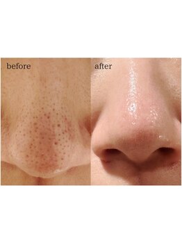 メンズフェイシャル