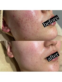 スプレミア(spuremia)/ニキビ症例