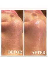 メンズプシュケ(men's PSYCHE)/毛穴洗浄