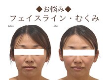 レジスタ(REGISTA)/【小顔矯正】before/after