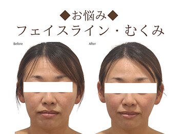 レジスタ(REGISTA)/【小顔矯正】before/after