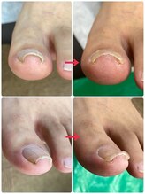 名古屋駅前巻き爪センター/巻き爪