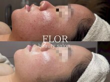 フロル(FLOR)の雰囲気（水光ピーリングで結果重視の【韓国肌管理】）
