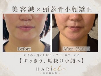美容鍼灸院ハリエル(HARIel)の写真/むくみ・エラ張り・食いしばりに◎美容鍼×頭蓋骨小顔矯正ですっきり小顔へ