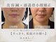 美容鍼灸院ハリエル(HARIel)の写真/むくみ・エラ張り・食いしばりに◎美容鍼×頭蓋骨小顔矯正ですっきり小顔へ