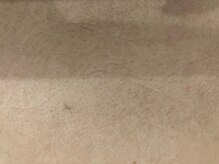 ムーンストーン(Moonstone)/高校生(背中)２回目施術前