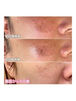 リセット(RESET)/佐世保 シミケア