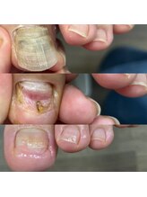 ウェルズユキ(well's yuki)/変形爪（色が変わった爪）