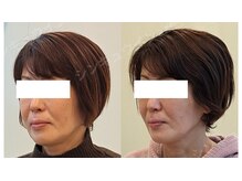 鍼灸院アゼ(AZE)/お顔の変化