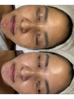 ココリール/ハーブピーリングでデトックス