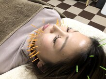 【美容鍼】たるみに対しての美容鍼の一例