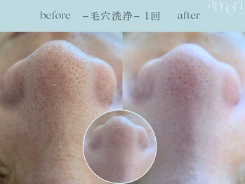 スキンラボアメリ(skin lab. ameri)/韓国式３D毛穴洗浄