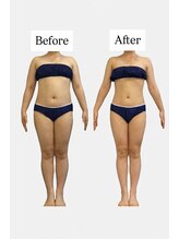 ラヴィ(Ravi)/人気オールハンド痩身コース150