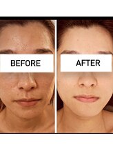 ジーニー(Genie)/「変化」するピーリング