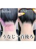 【両うなじ＋首後ろ】後ろ姿スッキリ♪自信UP◎　¥8,800
