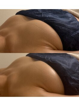 ミリミリ(mili mili)/before→after