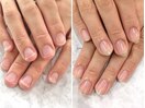 【深爪矯正】美爪に大変化◎