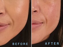 ウルリア(URURIA)/リフトアップ ビフォーアフター