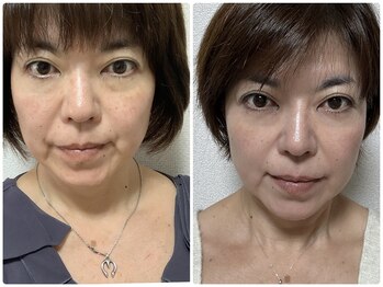 リンパドレナージュラナ(Rana)/フェイシャルケア