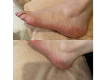安立鍼灸整骨院の雰囲気（角質ケアの施術1回目（個人差あり））