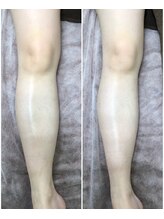 アルカンジュ(Archange)/ハイパー〈美脚コース〉