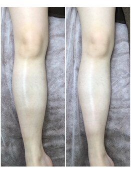 アルカンジュ(Archange)/ハイパー〈美脚コース〉