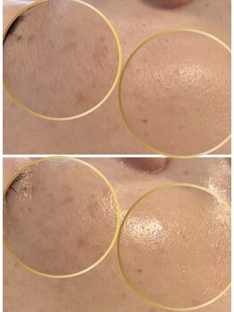 リミュール(Ri.miyuru)/小じわや毛穴もここまで変化