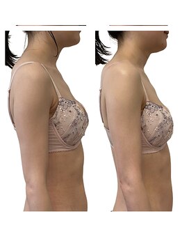 ベンザイ 新潟店(BENZAI)/下垂、巻肩、全部整う