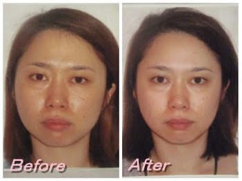 ドクター ヴィーナス/歪み改善の症例