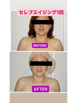 ボディグロス 梅田店(BODY GLOSS)/セレブエイジング1回