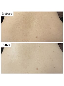 ベル 恵比寿(Belle)/REVI陶肌ハーブピーリング