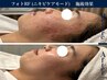 【人気NO.2】赤ら顔、敏感肌、ニキビケアに　光RFフェイシャル　¥2,980-