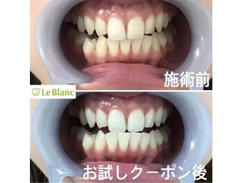 ルブラン 奈良店(Le Blanc)/綺麗な白い歯!