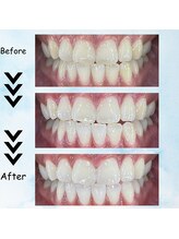 エクシアホワイトニング 塩釜口駅前店/３０代後半女性の効果事例