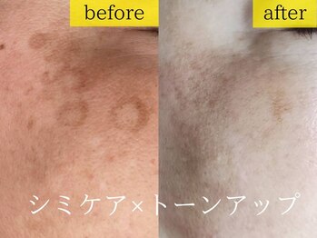 エステの森ジュジュ/【シミケア】ビフォーアフター