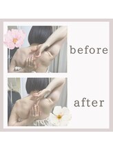 ビューティフィール アンド アリサナ(Beauty Feel&Arisana)/アリサナ症例写真　肩甲骨はがし