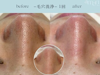 スキンラボアメリ(skin lab. ameri)/韓国式３D毛穴洗浄