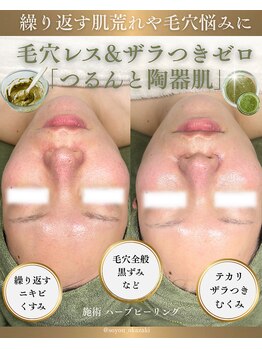 ソユ(SOYOU)/施術* ハーブピーリング