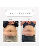 リメレ(Rimere)/スカルプト10回Before・after