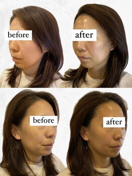 ビーアイリー(Be irie)/フェイシャルエステ直後の変化