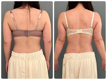 カナエルサロン 旭川(KANAERU SALON)/【バストアップ】症例☆