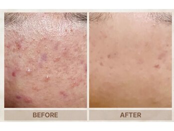 ベニバナ 五反田駅前/エクソソームスピキュールピール