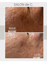 サロンドシー(SALON de C.)/シワ・しみ改善