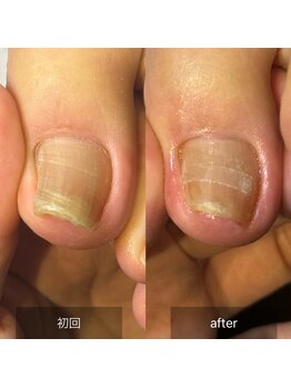 アイル(isle)/【巻き爪でお悩み】のお客様