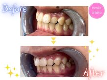 エクシアホワイトニング 天神店/ホワイトニングビフォーアフター